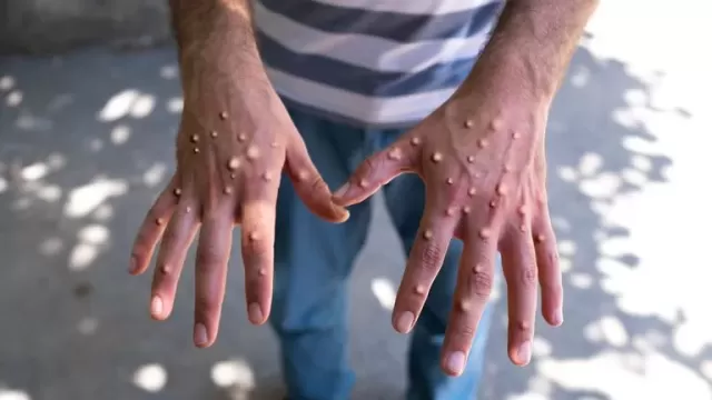 California Faces New Mpox Threat: Clade I Emerges