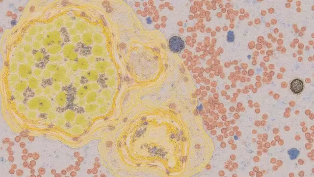 Natural Compound Boosts Leukemia Treatment Hope